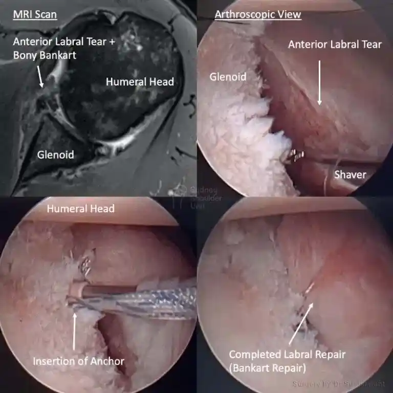 Series of 4 surgery images of a shoulder joint when Dr Sushil Pant performed a torn labrum and bankart repair