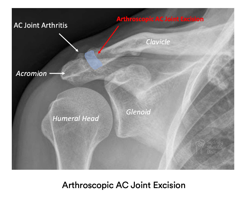 Arthroscopic AC Joint Resection Shoulder Surgery Sydney Shoulder Unit