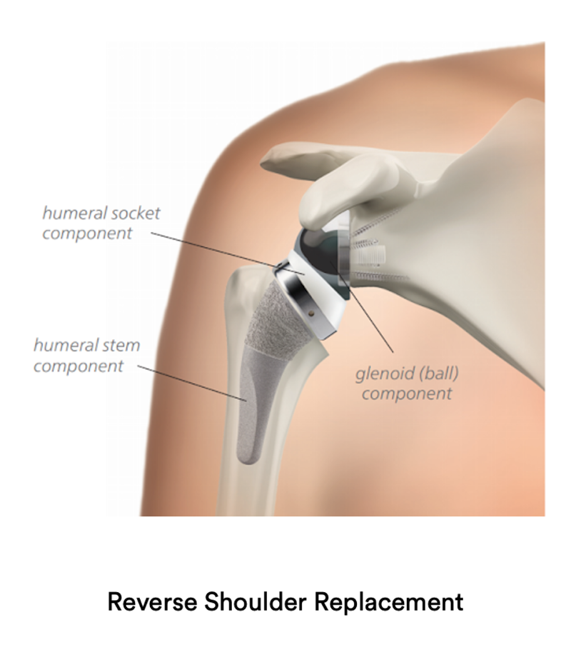 Reverse Shoulder Replacement Shoulder Surgery Sydney Shoulder Unit