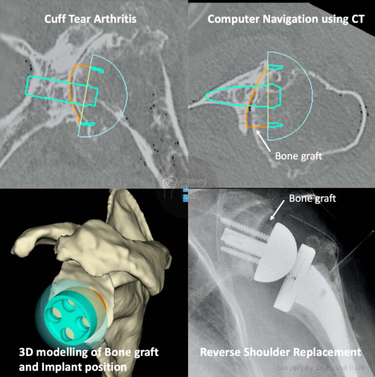 Reverse Shoulder Replacement Shoulder Surgery Sydney Shoulder Unit