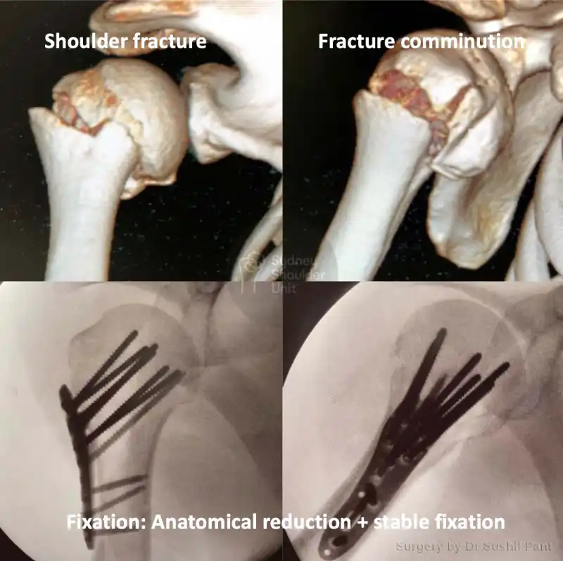 A series of 4 surgical images showing the before and after surgery to repair a proximal humerus fracture