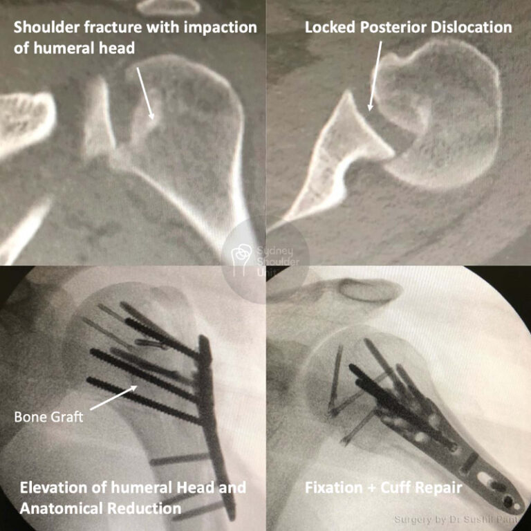 Proximal Humerus (Shoulder) Fracture | Shoulder Surgery | Sydney ...