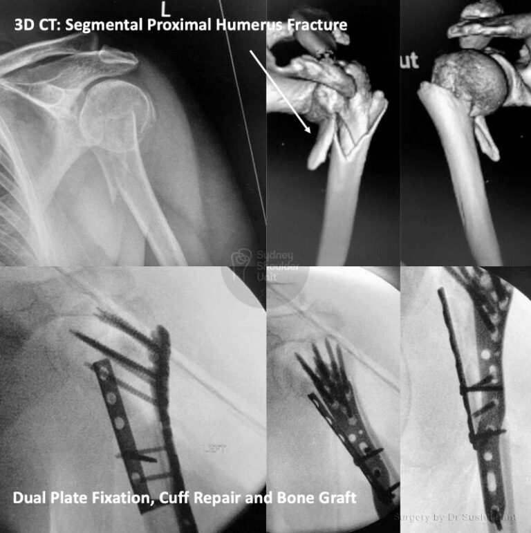 Proximal Humerus Shoulder Fractures | Sydney Shoulder Unit